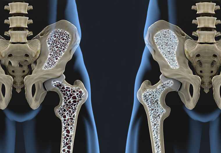 osteoporoza kosti krhke kosti lomljive kosti